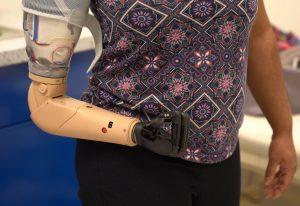 Myoelektrische Armprothesen